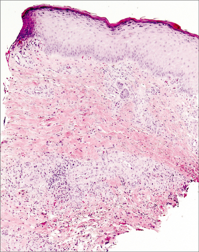 Wound infection by after penetrating plant injury - Indian Journal of ...