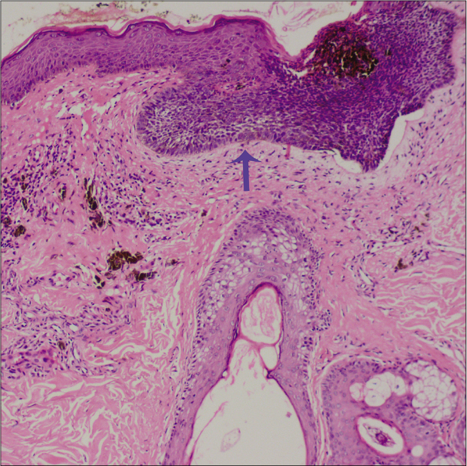 Dermoscopic Features Of Basal Cell Carcinoma In Skin Of Color: A 