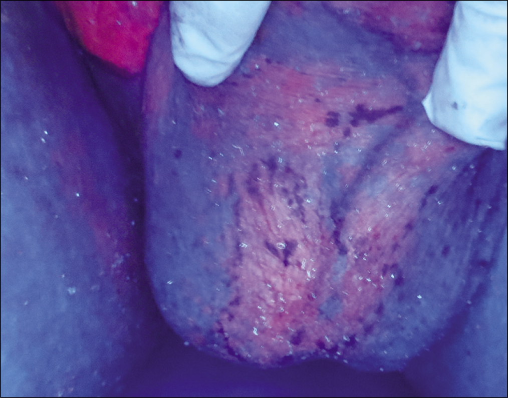 Brick-red region (3 × 2 cm) in the middle and lower scrotum with slightly weaker fluorescence intensity, under Wood’s lamp, after application of aminolevulinic acid