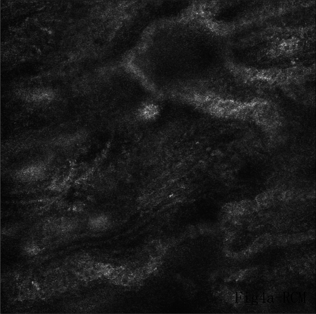 Weakly fluorescent region on reflectance confocal microscopy with various findings indicative of extramammary Paget’s disease