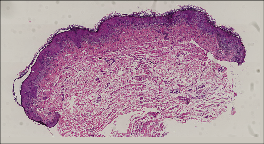 Several scattered or cluster like Paget cells in the weakly fluorescent region [hematoxylin and eosin (H & E), ×20]