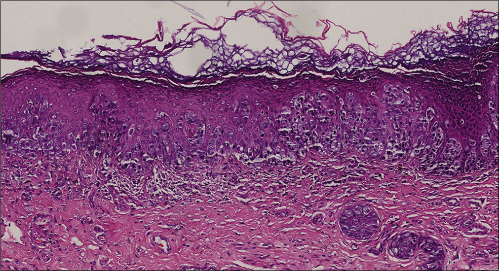 Several scattered or cluster like Paget cells in the weakly fluorescent region (H & E, ×200)