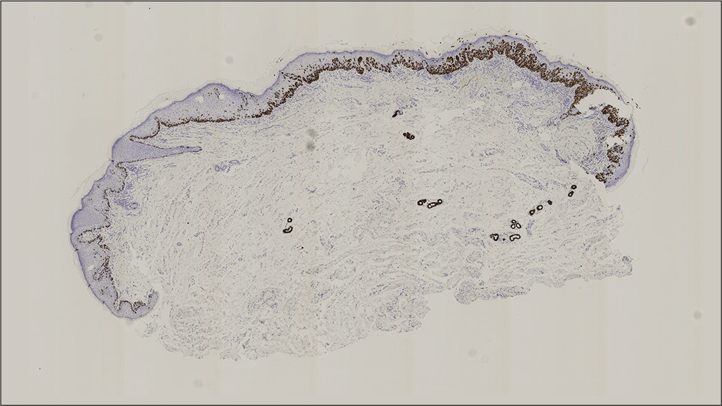 CK7 positive lesion on immunohistochemical analysis (×20)