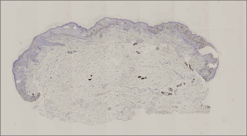 EMA positive lesion on immunohistochemical analysis (×20)