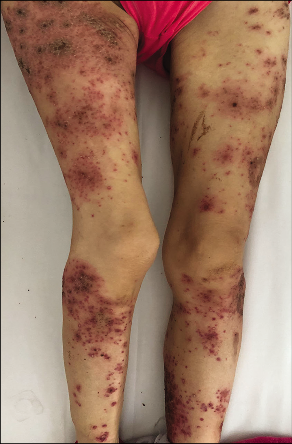 Erythematous scaly papules and pustules in the legs