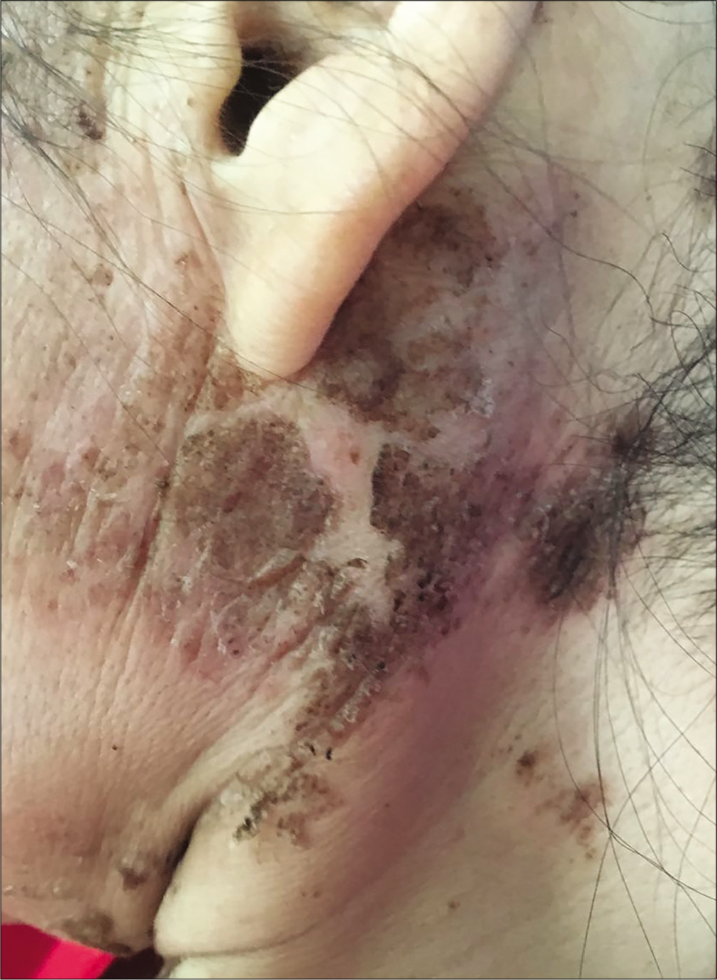 Erythematous scaly papules and pustules in the periauricular region