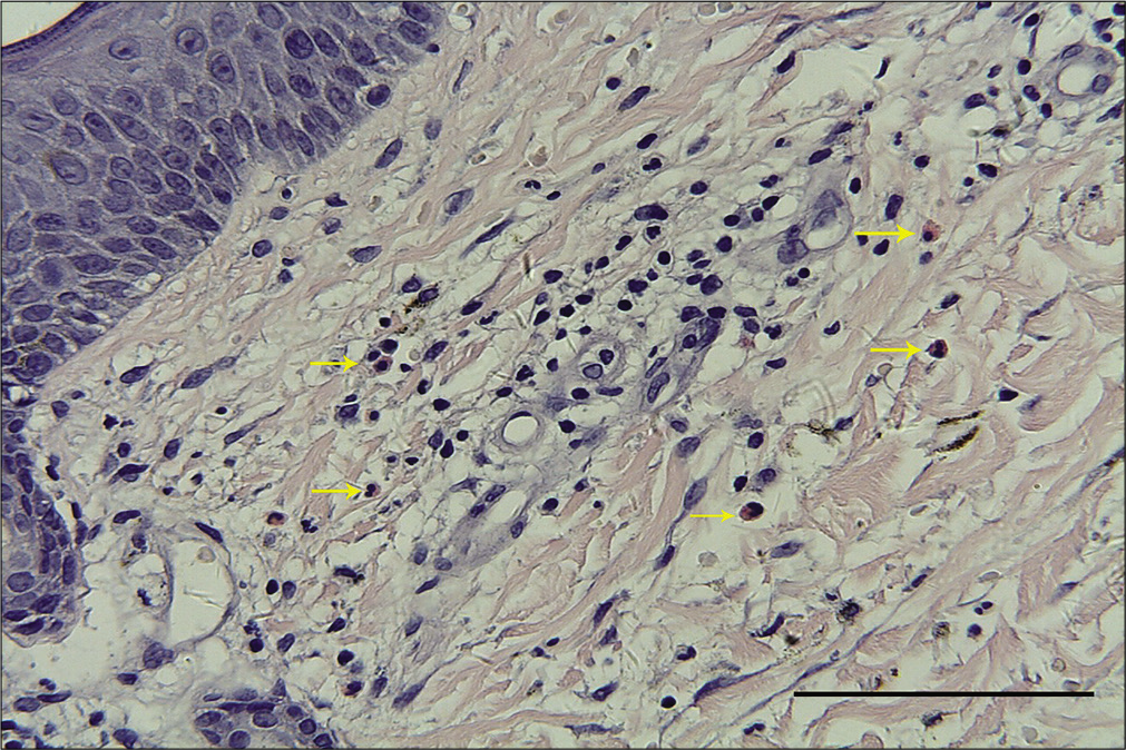 Moderate eosinophil infiltration (yellow arrows) around the vessels in the edematous papillary dermis (H and E, ×400, bar length = 100 μm)