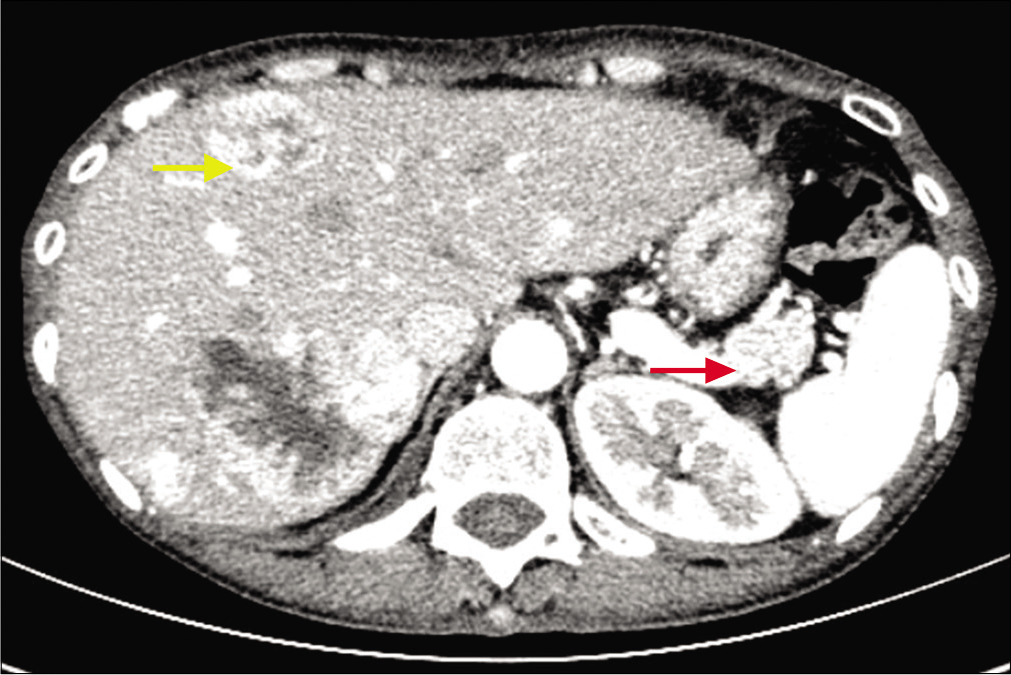 Enhanced abdominal computed tomography scan showing a mass in the tail of the pancreas (red arrow) and intrahepatic masses (yellow arrow)