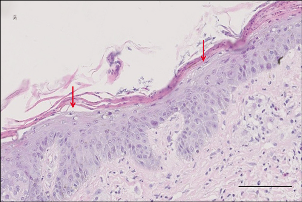 Epidermal parakeratosis and vacuolated keratinocytes (red arrows) in the upper spinous layer (H and E, ×400, bar length = 100 μm)