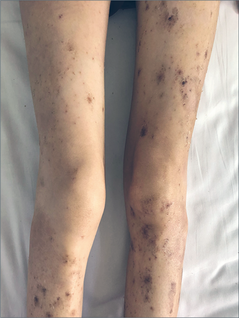 Obvious improvement of skin lesions on the legs