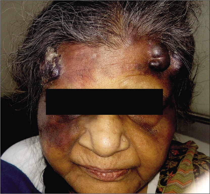 Pre-treatment picture showing multiple hemorrhagic bullae and reddish-purple nodules and plaques, over both sides of forehead surrounded with ecchymosis and dusky erythematous ecchymotic macule over right cheek