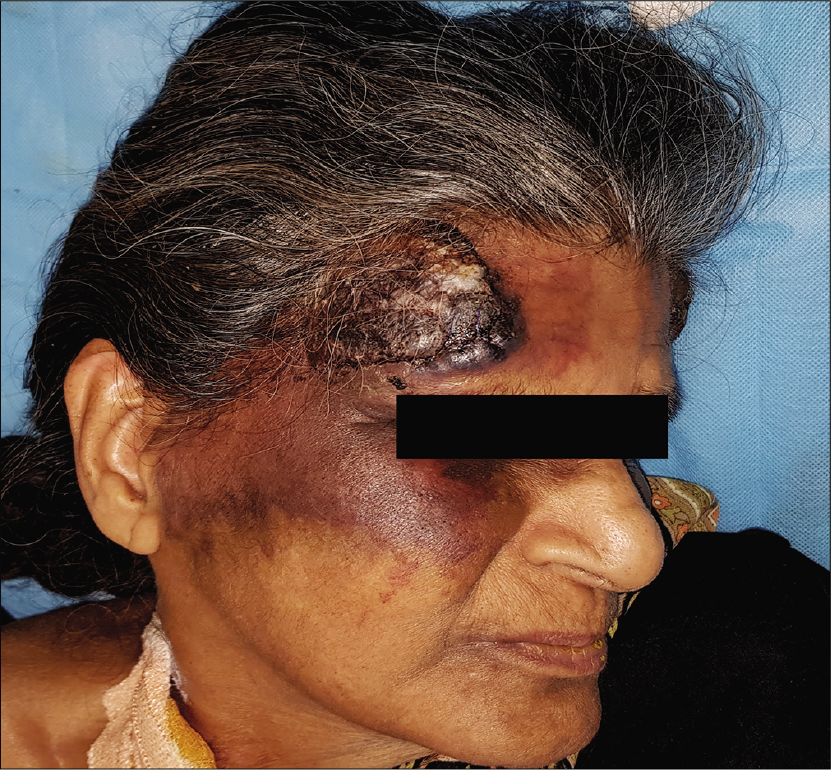 Pre-treatment picture showing a large dusky erythematous plaque over the right side of forehead with hemorrhagic crusting on the surface, surrounded by ecchymosis