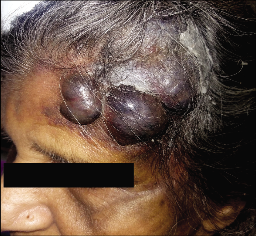 Pre-treatment picture showing multiple large hemorrhagic bullae and nodules and plaques over left side of forehead extending into the scalp