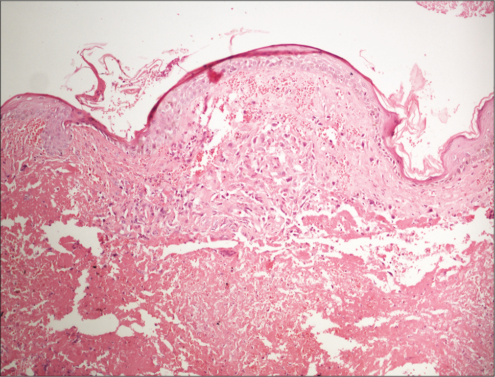 Skin biopsy showing irregular anastomosing channels in the dermis, lined by endothelial cells with enlarged and hyperchromatic nuclei dissecting in H and E, x 20