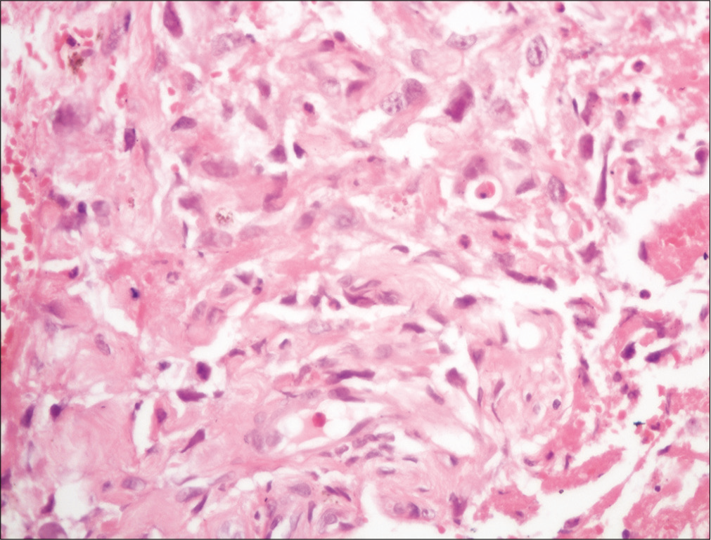 Skin biopsy showing irregular anastomosing channels in the dermis, lined by endothelial cells with enlarged and hyperchromatic nuclei dissecting in between collagen bundles (H and E, ×400)