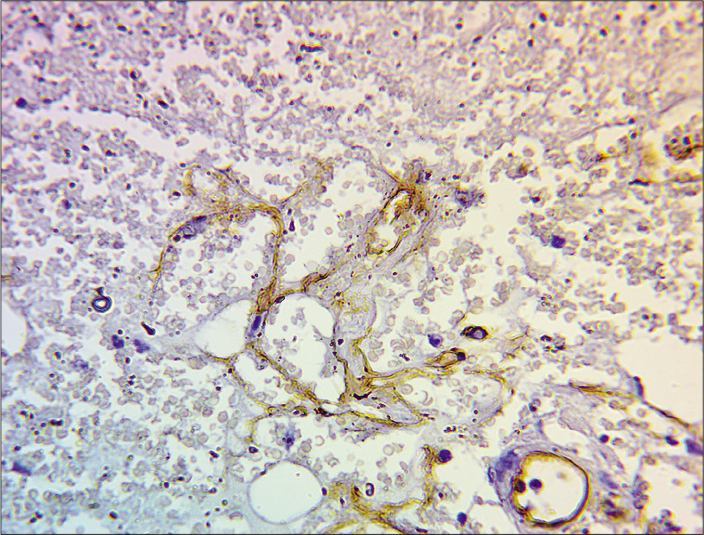 Immunohistochemistry showing atypical endothelial cells showing focal positivity to CD 34, in × 400