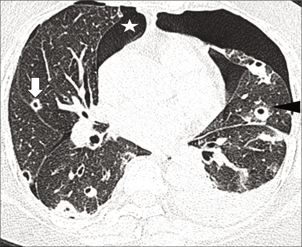 High-resolution computed tomography chest axial lung window images show multiple random nodules, predominantly cavitary (white thick arrows), and some noncavitary (white thin arrow) with surrounding ground-glass opacities (arrowhead). Mild right pneumothorax (asterisk) and left hydropneumothorax (black arrow) are also noted