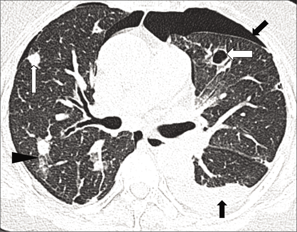 High-resolution computed tomography chest axial lung window images show multiple random nodules, predominantly cavitary (white thick arrows), and some noncavitary (white thin arrow) with surrounding ground-glass opacities (arrowhead). Mild right pneumothorax (asterisk) and left hydropneumothorax (black arrow) are also noted