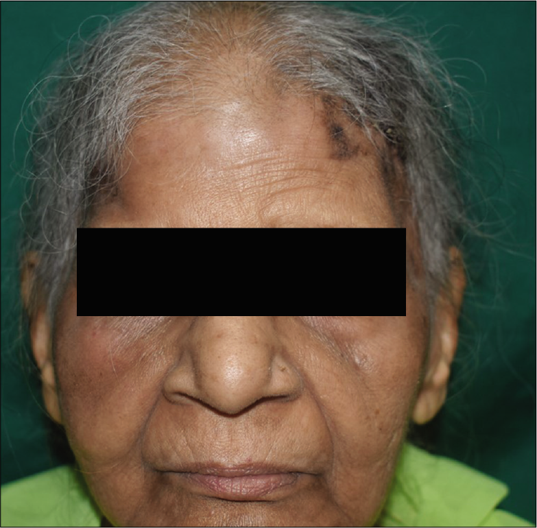 Post-treatment picture (after 5 cycles of chemotherapy) showing significantly reduced lesions and complete resolution of ecchymosis over both sides of forehead and right cheek