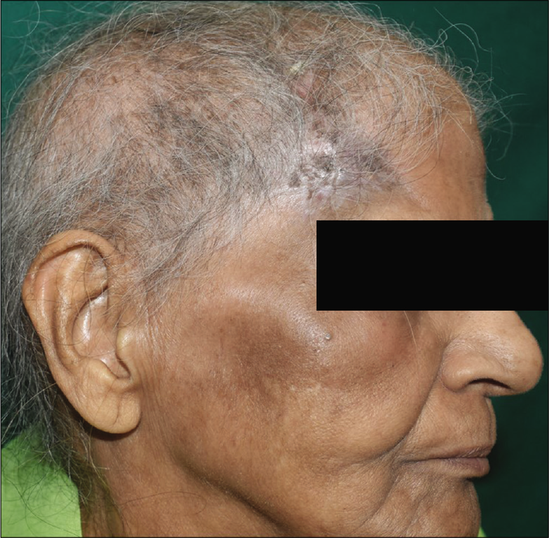 Post-treatment picture (after 5 cycles of chemotherapy) showing almost complete resolution of the plaque and surrounding ecchymosis over the right side of forehead with minimal residual crusting