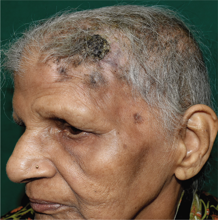 Post-treatment picture (after 5 cycles of chemotherapy) showing resolution of bullous nodules and plaques with minimal residual crusting