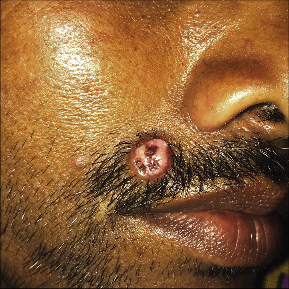 Solitary skin-colored to erythematous nodule on the right side of the upper lip