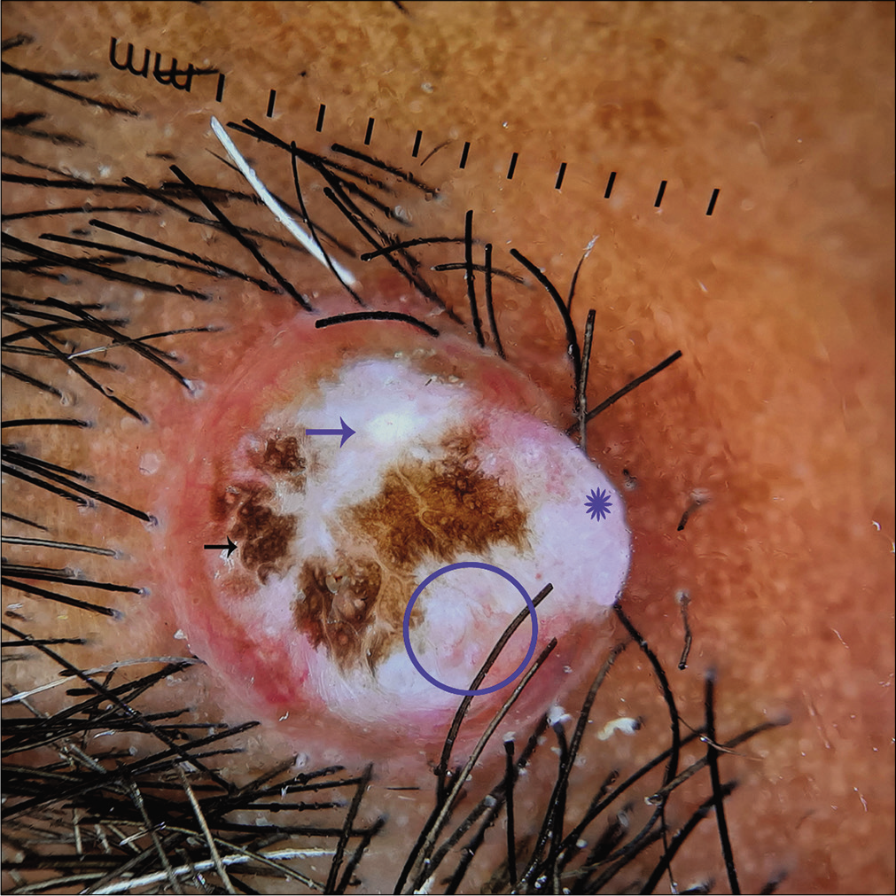 Dermoscopy under polarized mode (Dermlite DL4, ×10) showing white structureless area (Asterix), milia-like cyst (blue arrow), irregular brown blotches with a few white lines (black arrow), peripheral erythematous rim and linear curved vessels (circle)