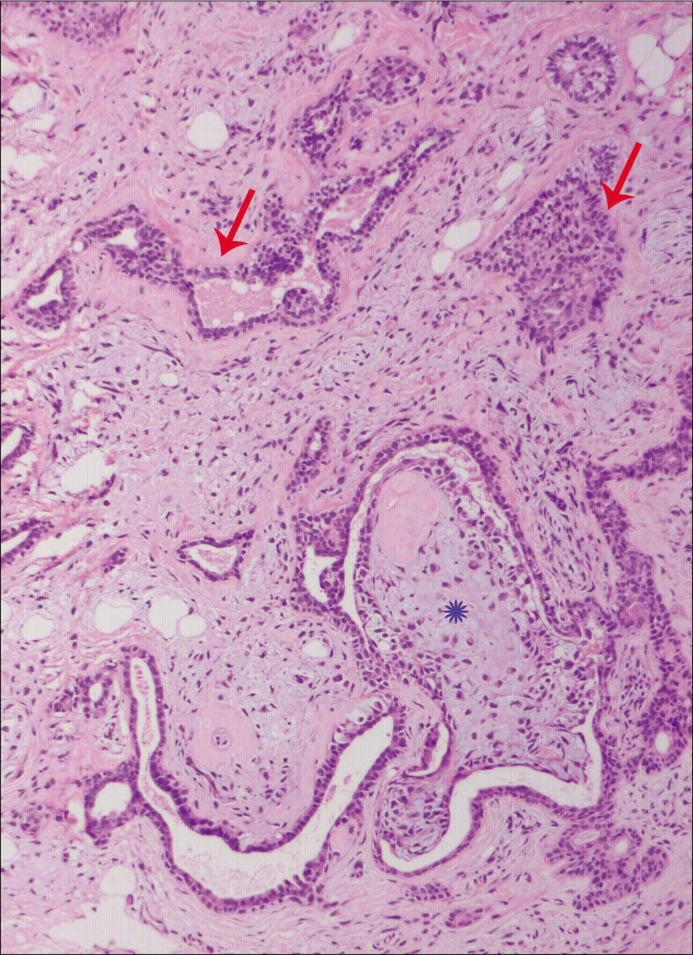 The proliferating epithelial cells arranged in nests, irregular tubulo-alveolar and ductal structures (red arrows) and lined by two layers of epithelial cells in a myxoid to fibromyxoid matrix (Asterix, H and E, ×100)