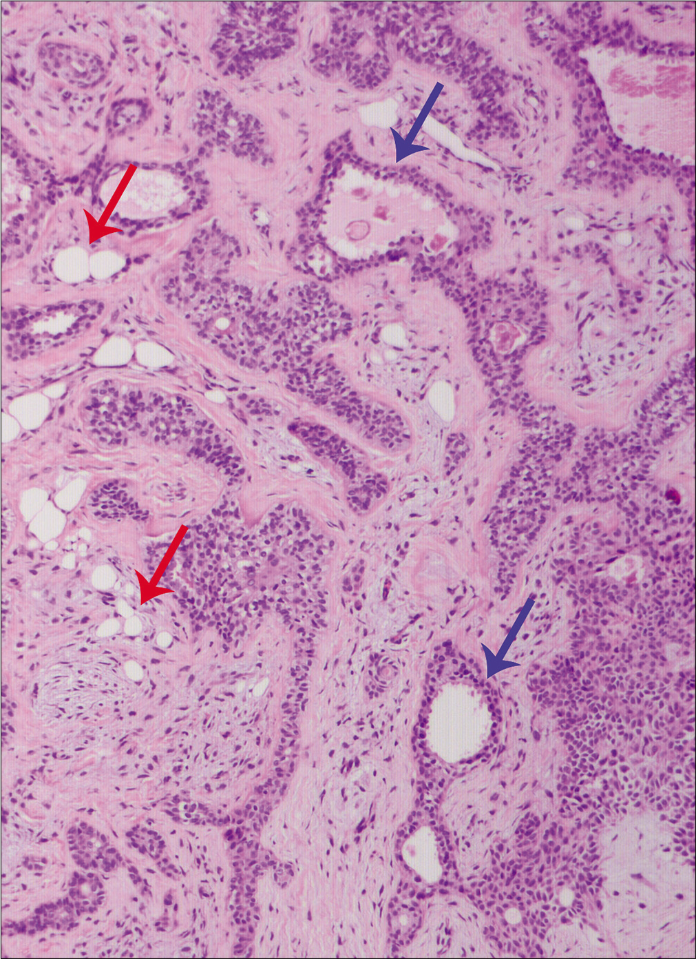 Apocrine decapitation secretion (blue arrows) and mature fat cells (red arrows, H and E, ×100)