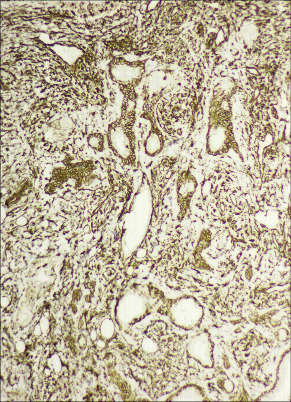 Immunohistochemistry showing vimentin positivity (IHC, ×100)