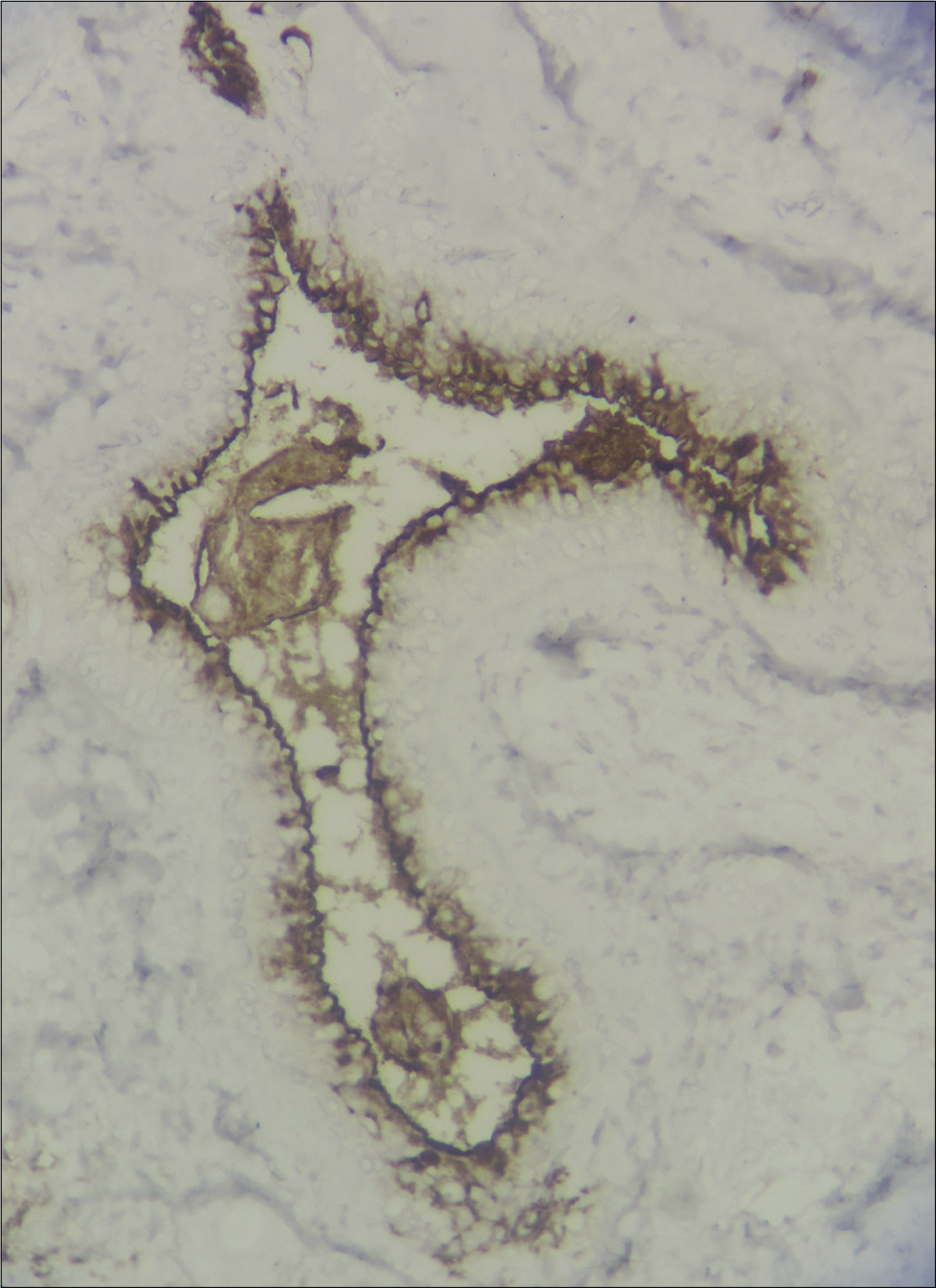 Immunohistochemistry showing carcino-embryogenic antigen positivity (IHC, ×400)