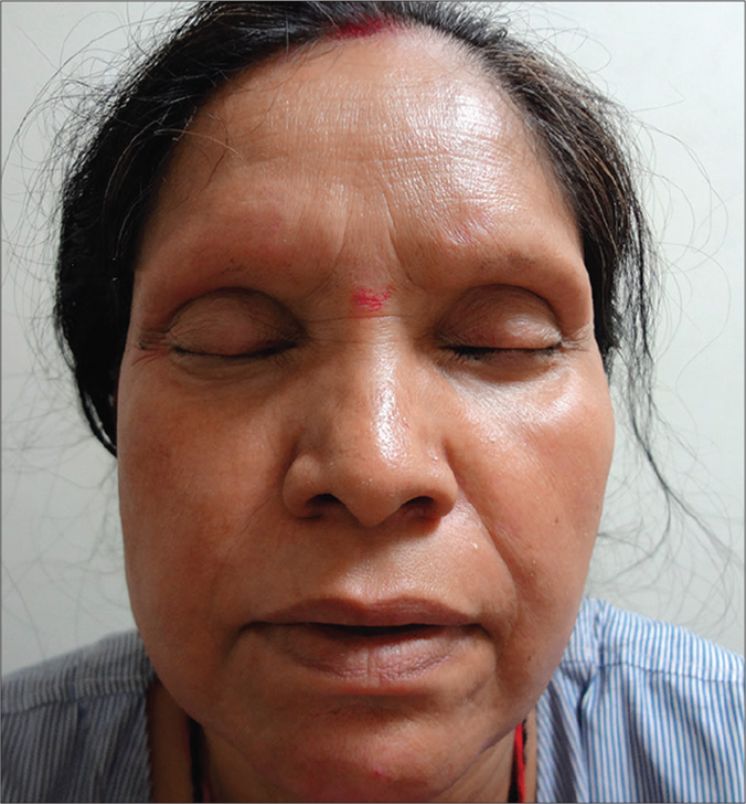 Erythematous shiny facial skin with the complete loss of eyelashes and eyebrows