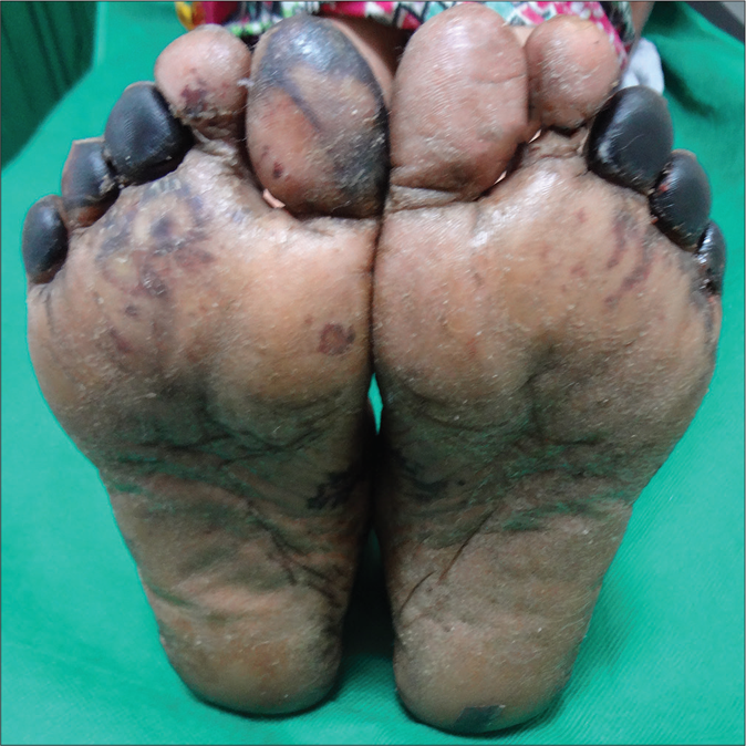 Gangrene involving multiple toes