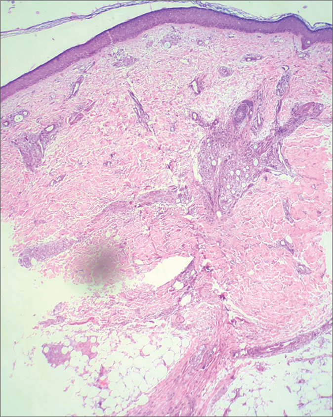 Biopsy from normal-appearing skin on thigh showing atrophic epidermis with periappendageal and perineural infiltrate (H&E, ×40)