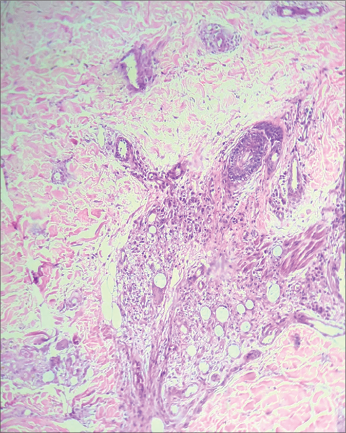 Periappendageal and perineural infiltrate of foamy macrophages and Virchow’s cells. (H&E, ×100)