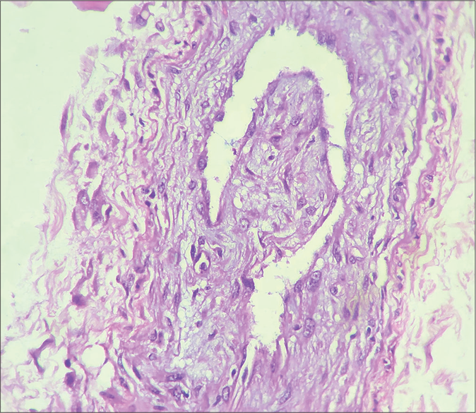 Infiltrate of foamy macrophages invading medium-size vessel (H&E, ×400)