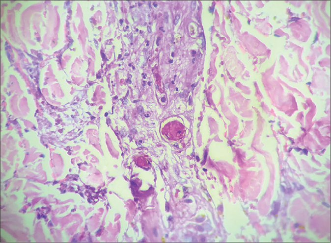 Vessels in mid dermis showing thrombosis without signs of vasculitis (H&E, ×400)