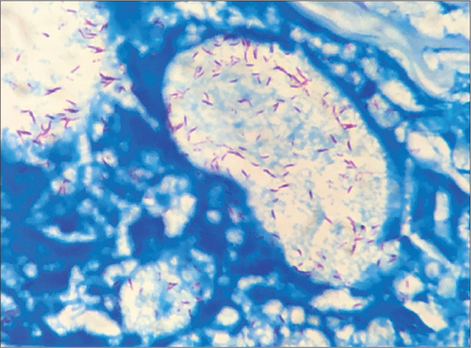 Presence of lepra bacilli in Virchow’s Cell (Fite Faraco stain, ×1000)