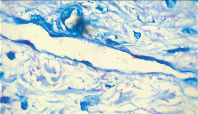 Lepra bacilli invading vessel wall and vascular lumen (Fite Faraco stain, ×1000)