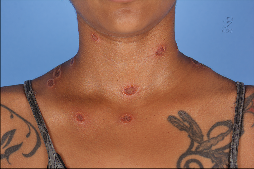 Tinea Corporis - Dermatology - Medbullets Step 1