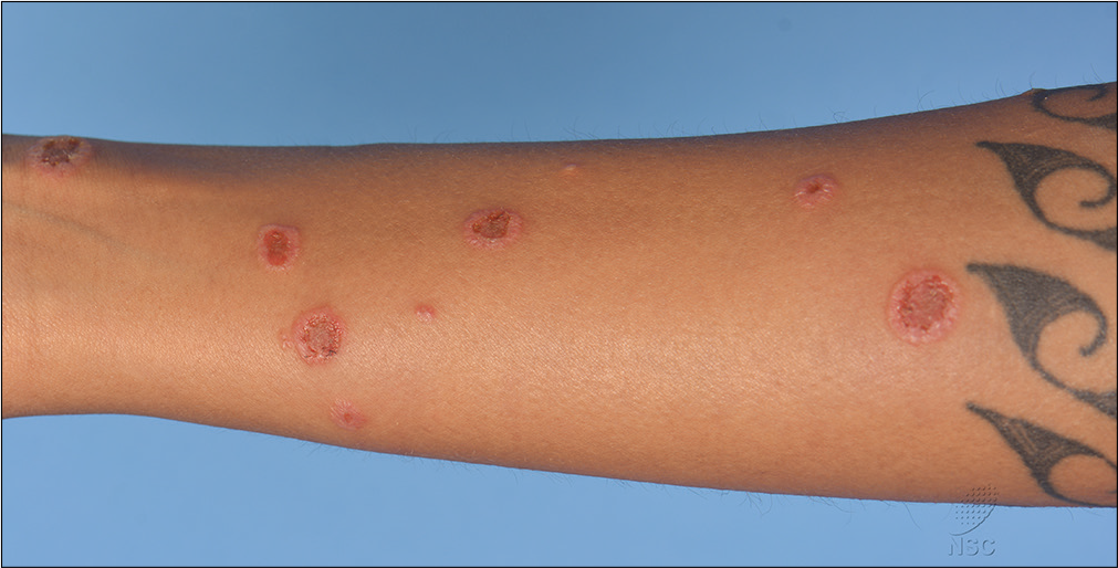 Targetoid bullous tinea corporis: Unusual presentation of a