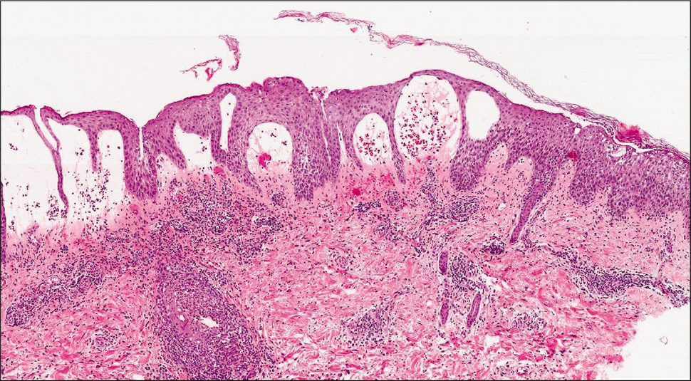 Tinea Corporis - Dermatology - Medbullets Step 1