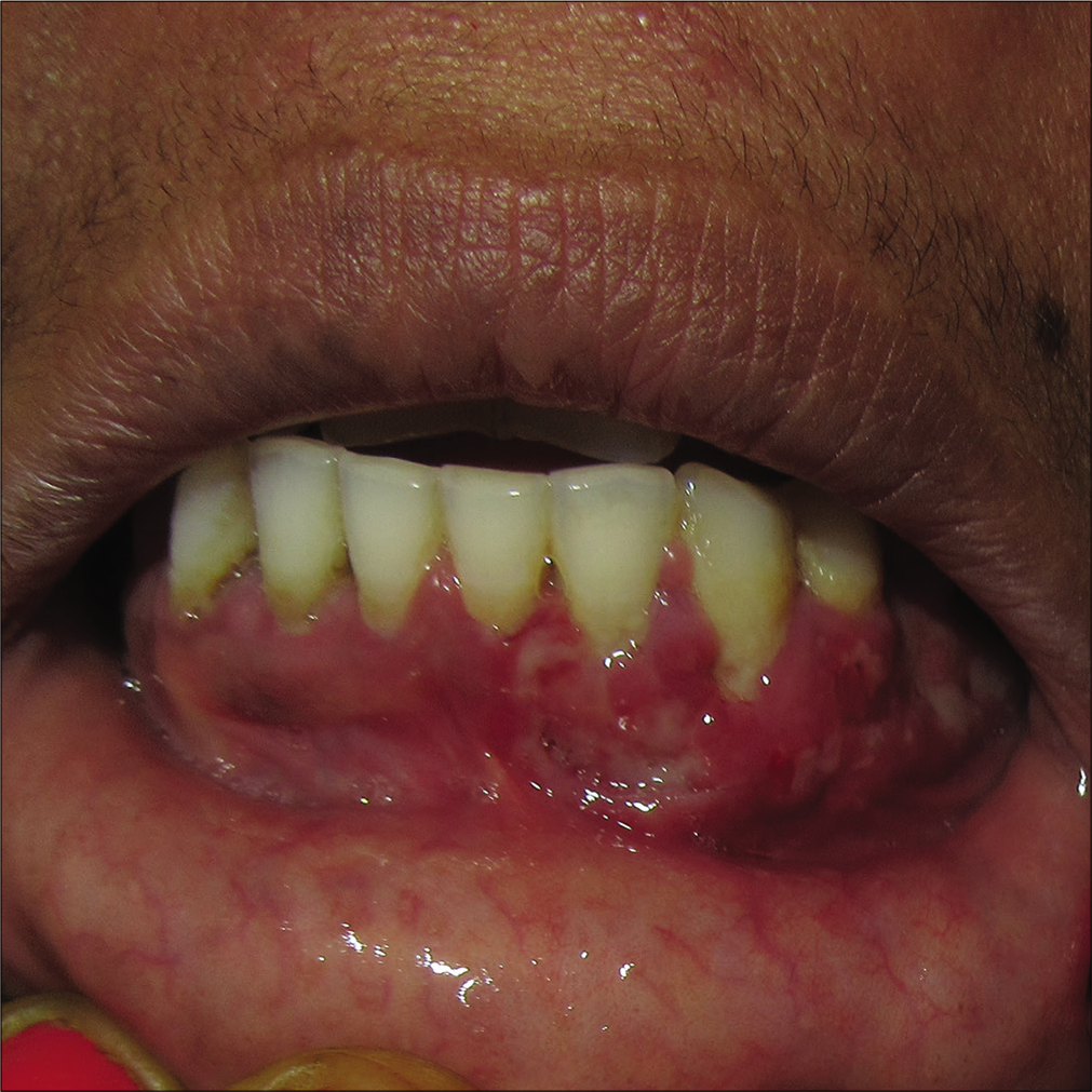 Focal ulcero-proliferative gingivitis: A rare presentation of mucosal ...