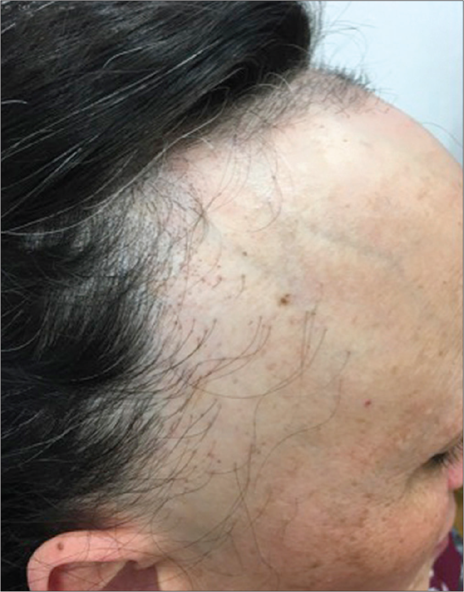 Right (a) and frontal (b) views, showing frontal and fronto-temporal hairline recession with isolated hairs in the original temporal hairline. Pseudo- fringe-sign was noted in the frontal area, along with hairs shorter than the normal ones