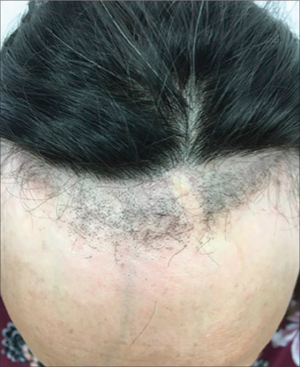 Right (a) and frontal (b) views, showing frontal and fronto-temporal hairline recession with isolated hairs in the original temporal hairline. Pseudo-fringe-sign was noted in the frontal area, along with hairs shorter than the normal ones