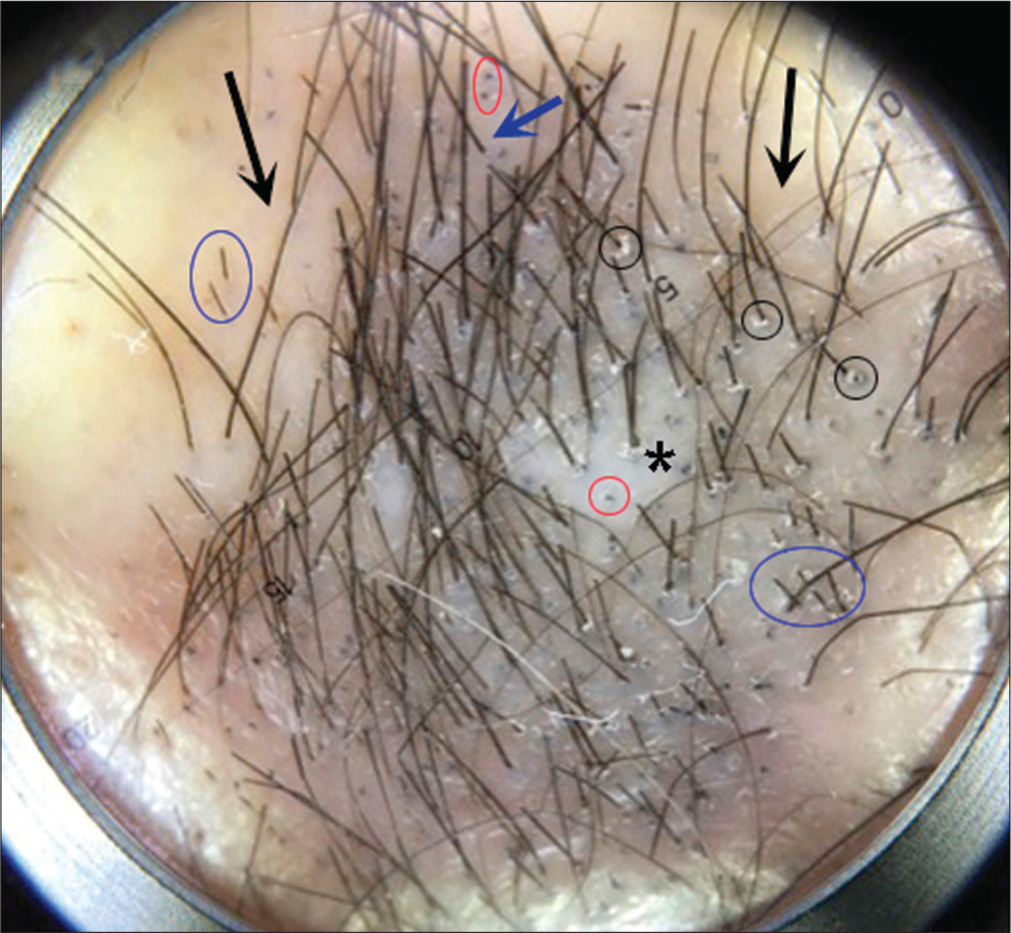 Dermoscopy showed black dots (red circles) and short black hairs with sharp ends (blue circles), in addition to loss of follicular openings (black arrows), follicles with one hair shaft (blue arrow), follicular hyperkeratosis (black circles) and white areas (asterisk) (Photofinder, polarized light, ×100)