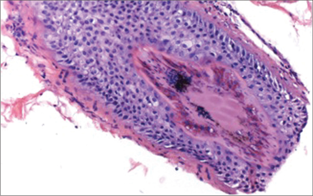 Histopathological image (H and E, ×200) showing pigmented hair casts and absence of inflammatory infiltrate