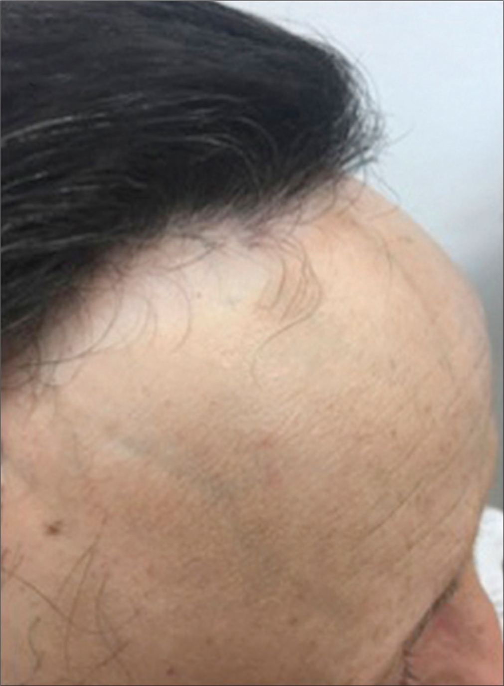 Recovering of the factious alopecia in the frontal area at 6 months. Note the persistence of the frontal recession because of the coexistence with frontal fibrosing alopecia