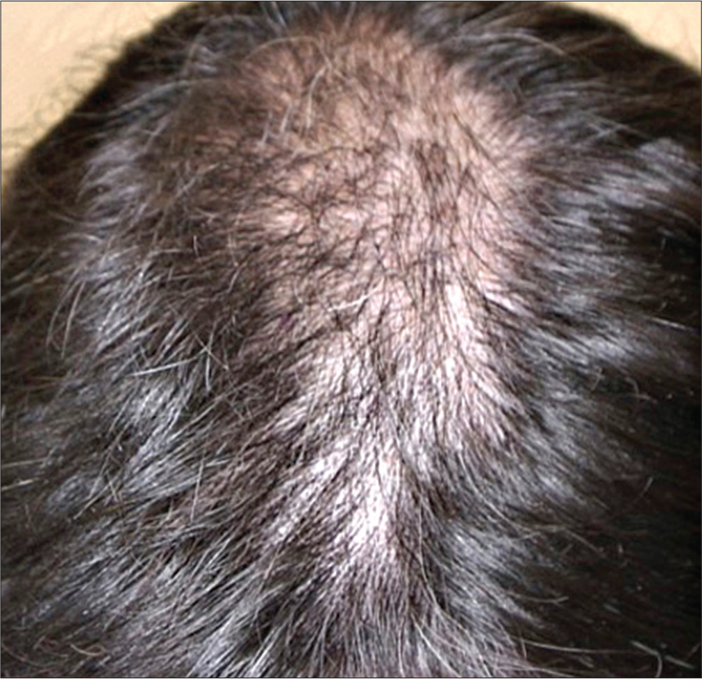 Decreased hair density in the parieto-occipital region