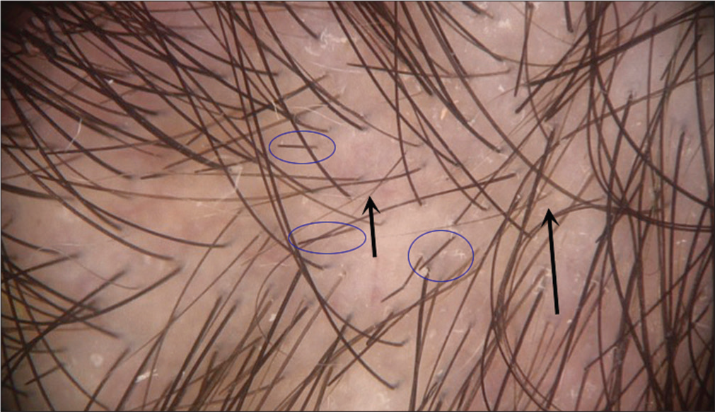 Dermoscopy in parieto-occipital region showed thin hairs (arrows) with hair diameter diversity, but again short black hairs with sharply cut ends (blue circles) (Photofinder, polarized light, ×100)